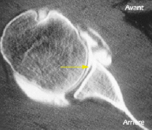 Lésion du bourrelet et des ligaments antérieurs