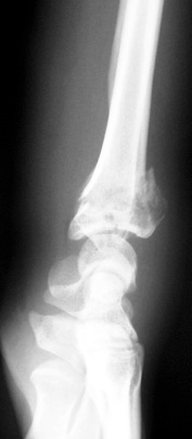 Fracture du poignet