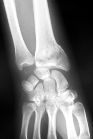 Fracture du poignet