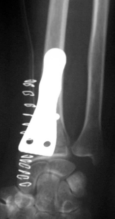 Fracture du poignet