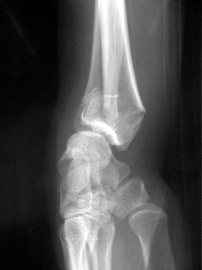 Fracture du poignet