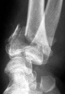 Fracture du poignet