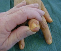 Kyste mucoïde du doigt
