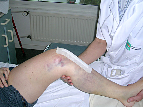 genou-chirurgie-rupture-ligament-croise-01 Rupture du ligament croisé antérieur