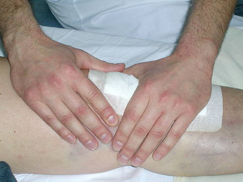 genou-chirurgie-rupture-ligament-croise-02 Rupture du ligament croisé antérieur