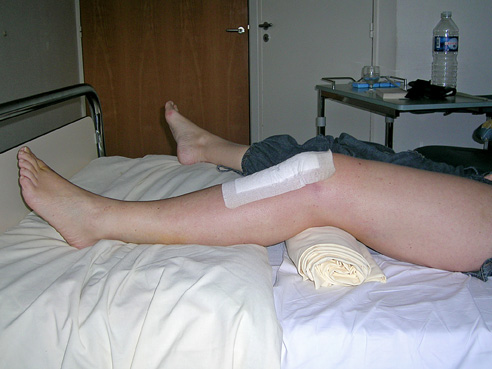 genou-chirurgie-rupture-ligament-croise-03 Rupture du ligament croisé antérieur
