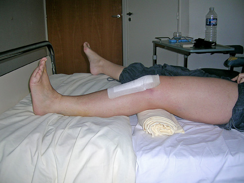 genou-chirurgie-rupture-ligament-croise-04 Rupture du ligament croisé antérieur