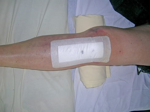 genou-chirurgie-rupture-ligament-croise-05 Rupture du ligament croisé antérieur