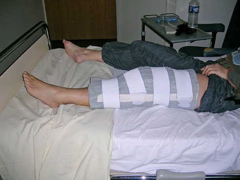 genou-chirurgie-rupture-ligament-croise-06 Rupture du ligament croisé antérieur