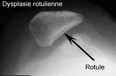 Les luxations de rotule