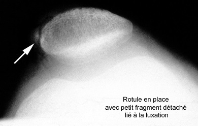 Les luxations de rotule - Orthopédie Brest