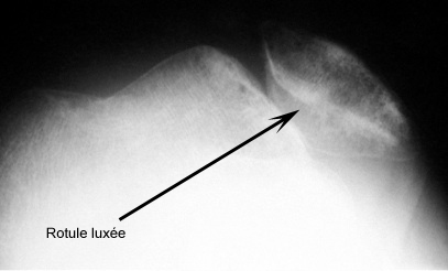 Les luxations de rotule - Orthopédie Brest