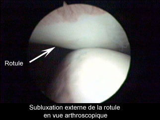 Les luxations de rotule