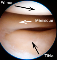 Les lésions des ménisques du genou