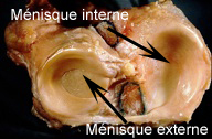 Les lésions des ménisques du genou