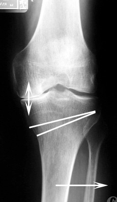 L'ostéotomie tibiale de valgisation