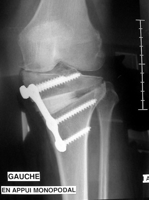 L'ostéotomie tibiale de valgisation