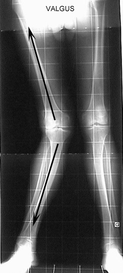 L'ostéotomie tibiale de valgisation