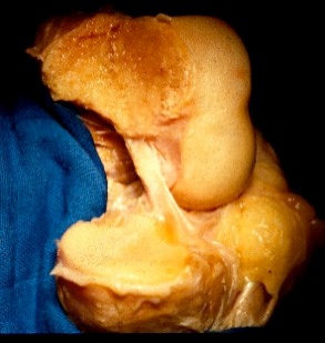 Rupture du ligament croisé antérieur