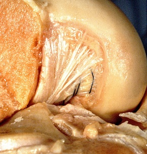 Rupture du ligament croisé antérieur