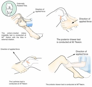 Rupture du ligament croisé antérieur