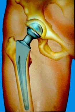 Prothèse totale de la hanche