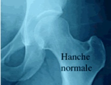 Prothèse totale de la hanche