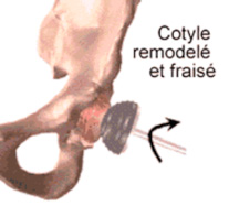 Prothèse totale de la hanche
