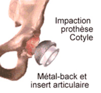Prothèse totale de la hanche