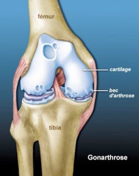 L'arthrose construit de l'os