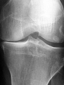 Arthrose interne sur génu-varum