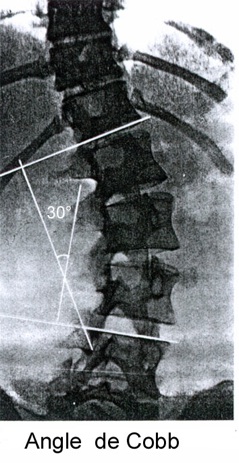 angle de Cobb scoliose